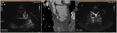 The Complementary Relationship Between Echocardiography and Multi-Slice Spiral CT Coronary Angiography in the Diagnosis of Coronary Artery Thrombosis in Children With Kawasaki Disease